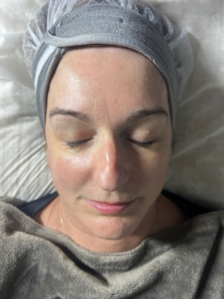 Antes - Higiene Facial Profunda