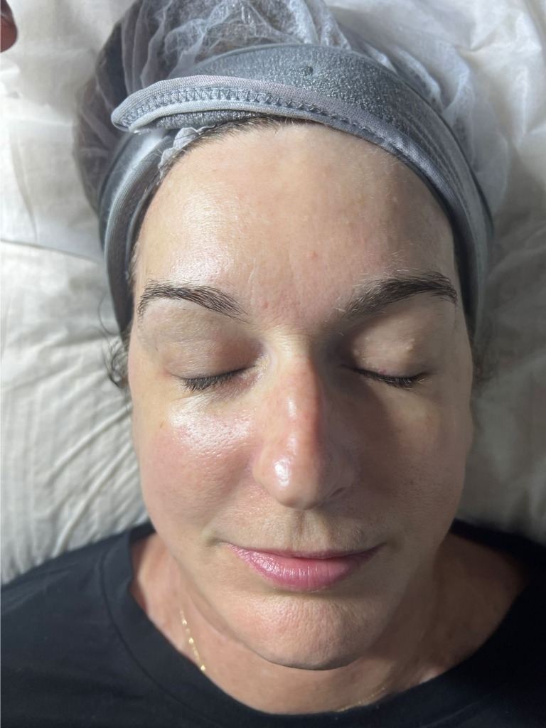 Después - Higiene Facial Profunda