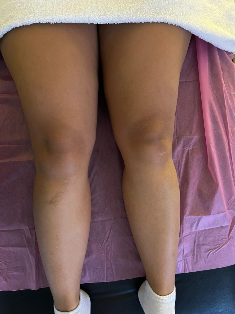 Antes - Masaje para Piernas Cansadas